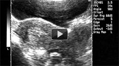 Ultrasound guided embryo transfer.